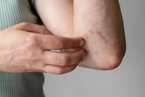 Vacina contra herpes-zóster fica fora do SUS decisão do Ministério da Saúde gera debate
