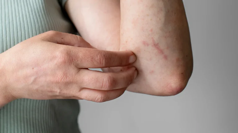 Vacina contra herpes-zóster fica fora do SUS decisão do Ministério da Saúde gera debate
