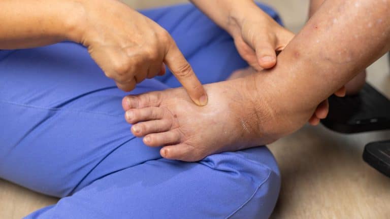 Lipedema: Entenda os Gatilhos Inflamatórios e Como Controlar a Doença