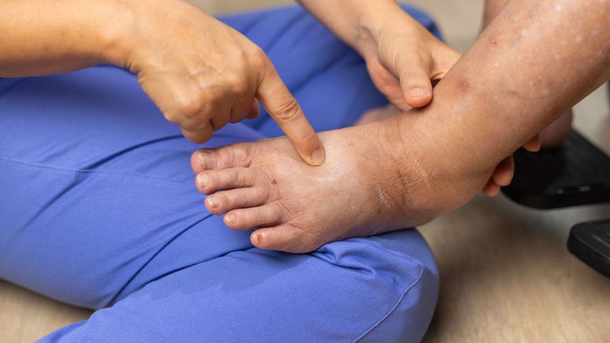 Lipedema: Entenda os Gatilhos Inflamatórios e Como Controlar a Doença