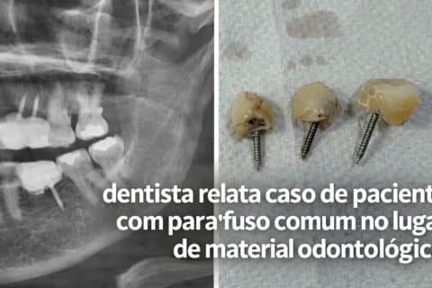 Não era implante e isso acendeu um alerta