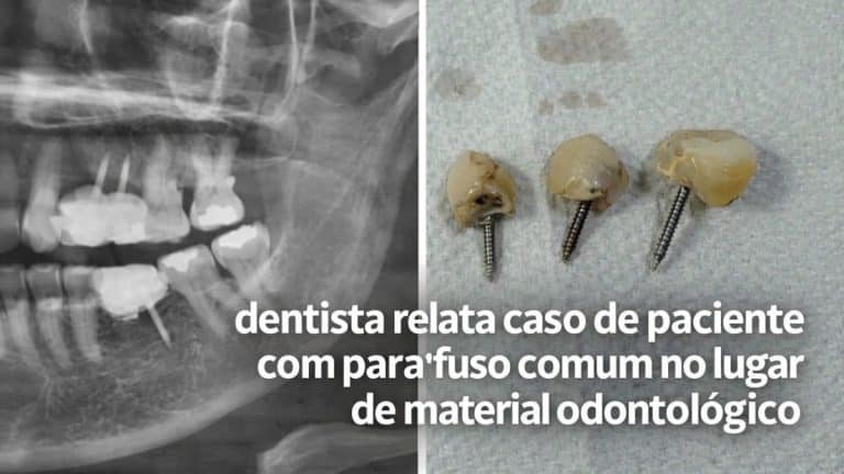 Não era implante e isso acendeu um alerta